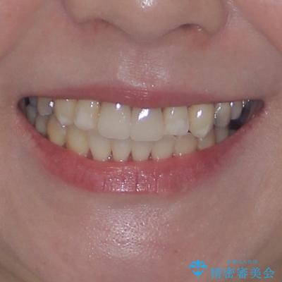 気になる前歯 ワイヤー矯正とセラミック治療の治療後(顔貌)