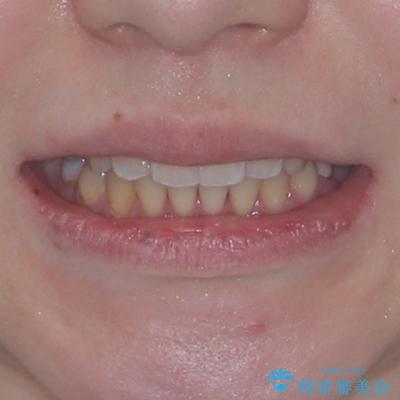 開咬と前方に飛び出した前歯 インビザラインによる矯正治療の治療後(顔貌)