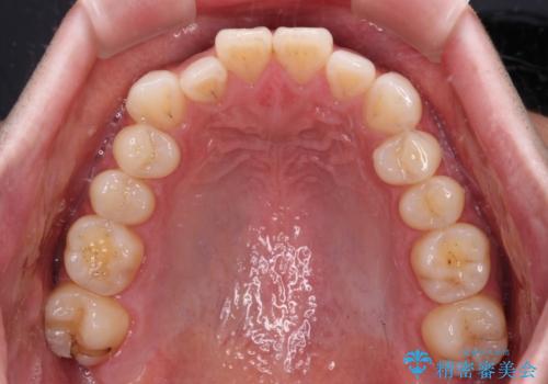 目立たない装置でデコボコを改善　ハーフリンガルによる矯正治療の治療前