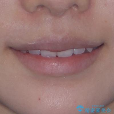 八重歯を確実に改善 補助装置を併用したインビザライン矯正治療の治療後(顔貌)