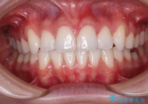 八重歯を確実に改善　補助装置を併用したインビザライン矯正治療