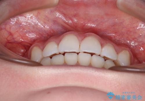 八重歯を確実に改善 補助装置を併用したインビザライン矯正治療の治療後