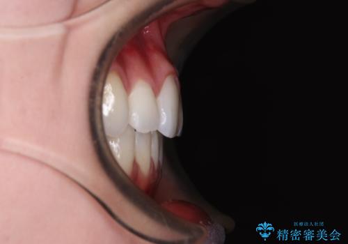 八重歯を確実に改善 補助装置を併用したインビザライン矯正治療の治療後