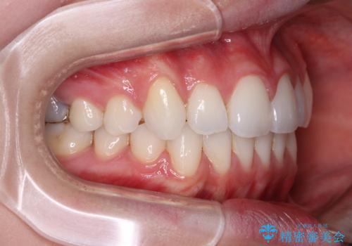 八重歯を確実に改善 補助装置を併用したインビザライン矯正治療の治療後