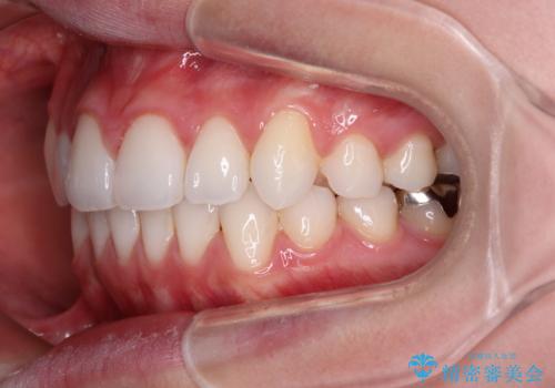 八重歯を確実に改善 補助装置を併用したインビザライン矯正治療の治療後