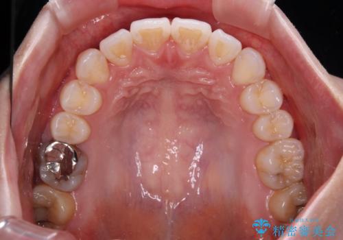 八重歯を確実に改善 補助装置を併用したインビザライン矯正治療の治療後