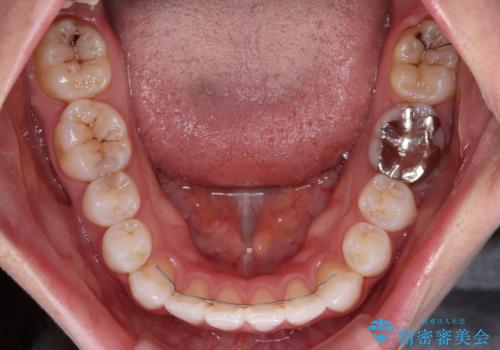 八重歯を確実に改善 補助装置を併用したインビザライン矯正治療の治療後