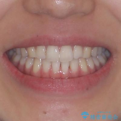 前歯の重なりをインビザライン・モデレートで矯正治療の治療後(顔貌)