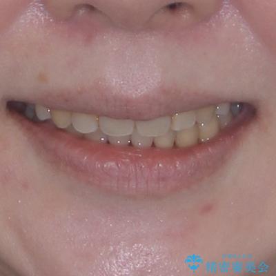 飛び出した上顎前歯と上下のデコボコ 片顎の抜歯によるワイヤー矯正の治療後(顔貌)