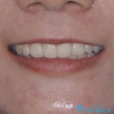 前歯のデコボコを解消 インビザラインの矯正治療の治療後(顔貌)