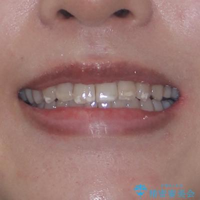 インビザライン・モデレートを用いて気になる前歯を短期間で矯正治療の治療後(顔貌)