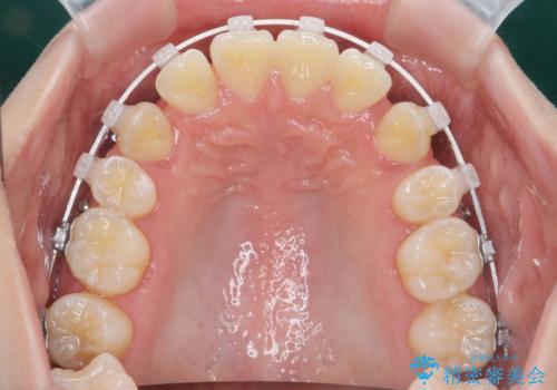 [ 八重歯を治す ]   小臼歯4本抜歯 マルチブラケット矯正の治療中