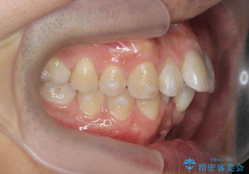 マウスピース矯正で前歯の角度、ガタガタをきれいに
