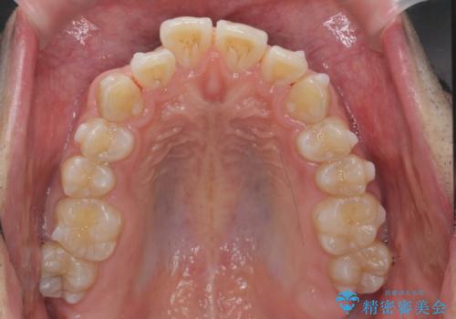 マウスピース矯正で前歯の角度、ガタガタをきれいにの治療中