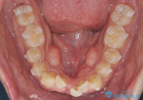 マウスピース矯正で前歯の角度、ガタガタをきれいにの治療中