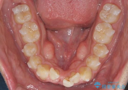 マウスピース矯正で前歯の角度、ガタガタをきれいにの治療中