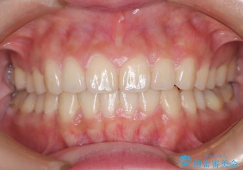 出っ歯、がたつきを治したい マウスピース矯正の症例 治療後