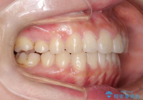 出っ歯、がたつきを治したい マウスピース矯正の治療後