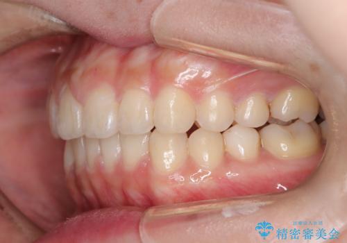 出っ歯、がたつきを治したい マウスピース矯正の治療後