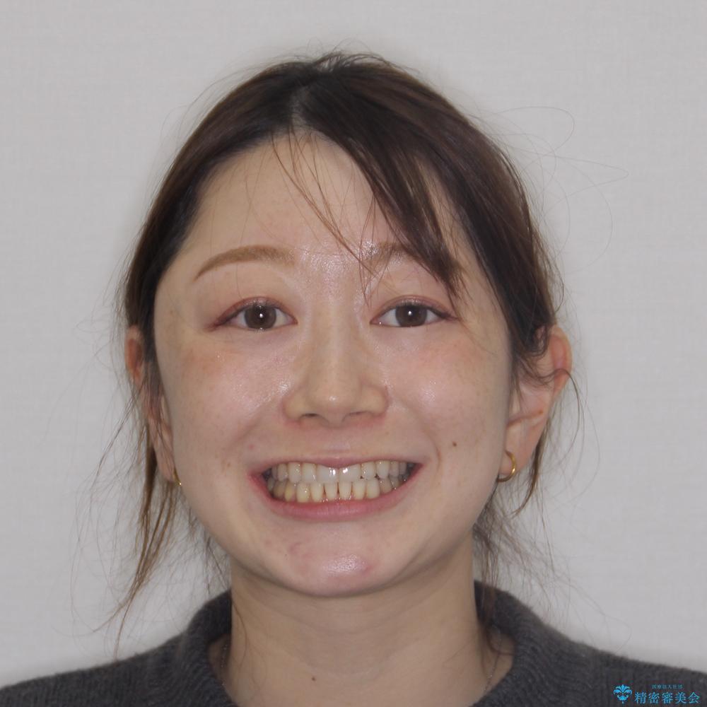 【モニター】顎のゆがみをカムフラージュ ワイヤー装置の抜歯矯正の治療後(顔貌)