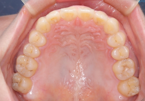 出っ歯、がたつきを治したい　マウスピース矯正の治療後