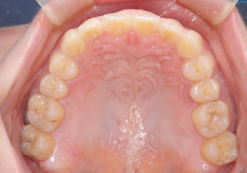 出っ歯、がたつきを治したい マウスピース矯正の治療後
