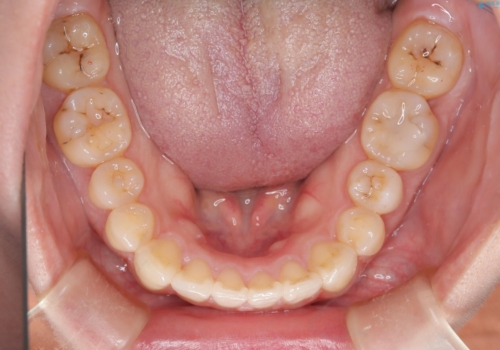 出っ歯、がたつきを治したい マウスピース矯正の治療後