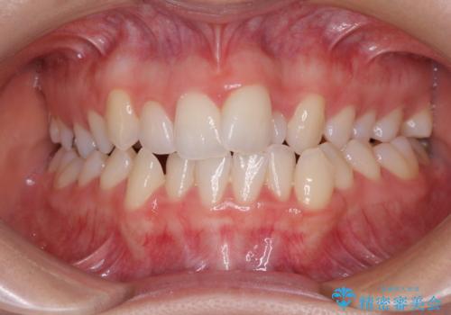 骨格的な問題を側方拡大で解決 ワイヤー矯正治療の症例 治療前