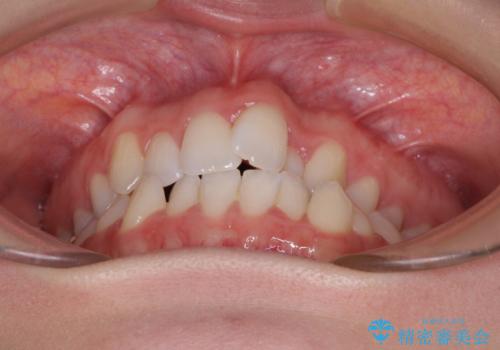 骨格的な問題を側方拡大で解決 ワイヤー矯正治療の治療前