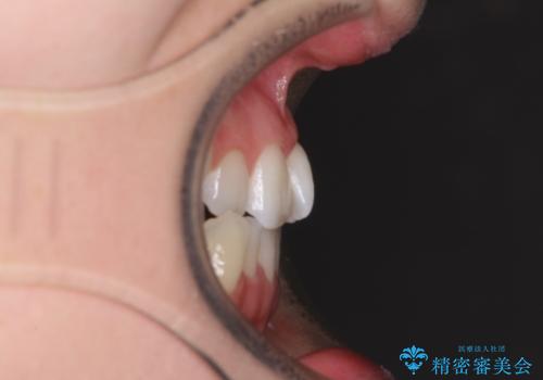 骨格的な問題を側方拡大で解決 ワイヤー矯正治療の治療前