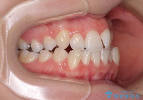 骨格的な問題を側方拡大で解決 ワイヤー矯正治療の治療前