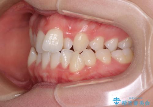 骨格的な問題を側方拡大で解決 ワイヤー矯正治療の治療前