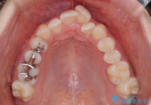 骨格的な問題を側方拡大で解決　ワイヤー矯正治療の治療前