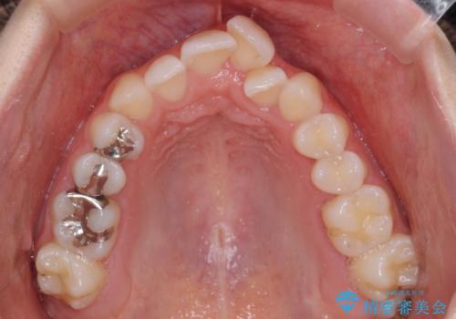 骨格的な問題を側方拡大で解決 ワイヤー矯正治療の治療前