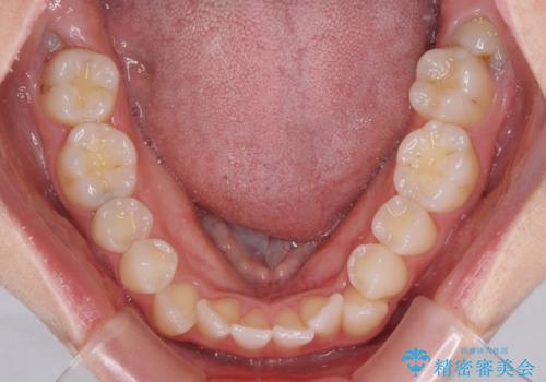 骨格的な問題を側方拡大で解決 ワイヤー矯正治療の治療前