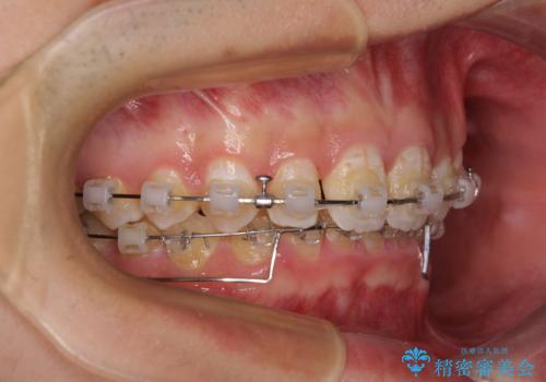食いしばり癖を改善したい ディープバイトのワイヤー矯正の治療中