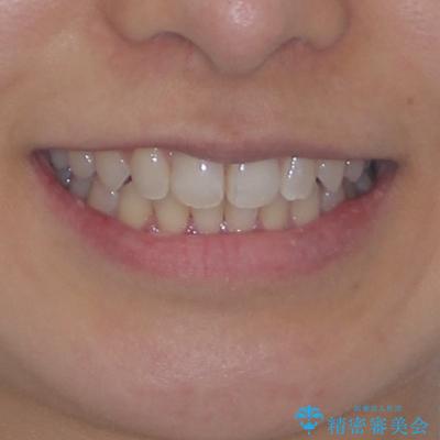 埋もれた奥歯をワイヤーで改善 インビザラインによる矯正治療の治療後(顔貌)