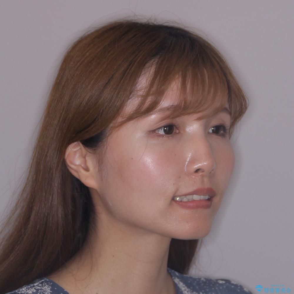 【モニター】上顎前突と奥歯の鋏状咬合 補助装置を用いたインビザライン矯正治療の治療後(顔貌)