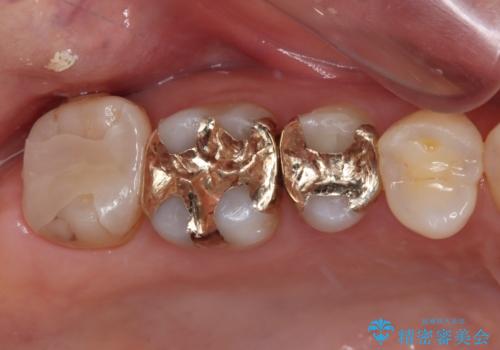 奥歯の銀歯をゴールドでしっかりと治療の症例 治療後