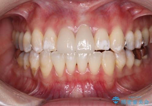 気になる前歯 ワイヤー矯正とセラミック治療の症例 治療後