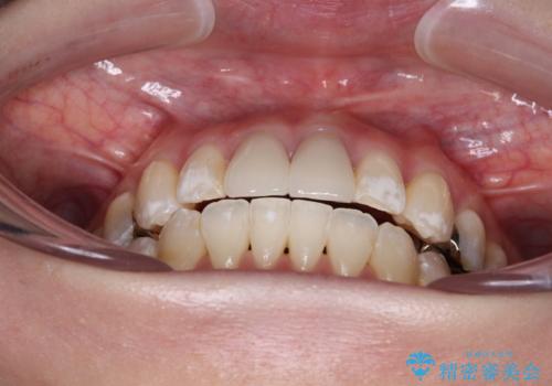 気になる前歯 ワイヤー矯正とセラミック治療の治療後