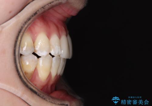気になる前歯 ワイヤー矯正とセラミック治療の治療後