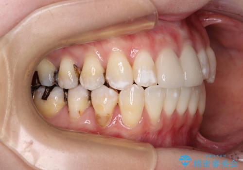 気になる前歯 ワイヤー矯正とセラミック治療の治療後