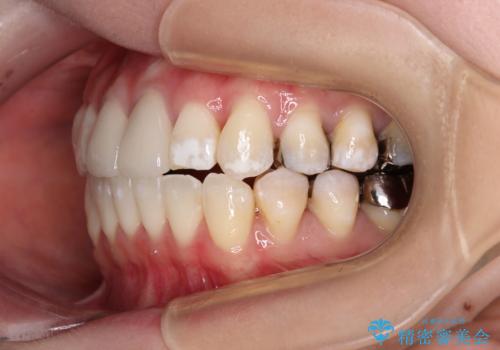 気になる前歯 ワイヤー矯正とセラミック治療の治療後