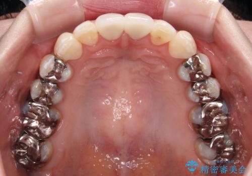 気になる前歯 ワイヤー矯正とセラミック治療の治療後