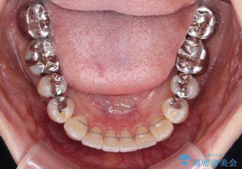気になる前歯 ワイヤー矯正とセラミック治療の治療後