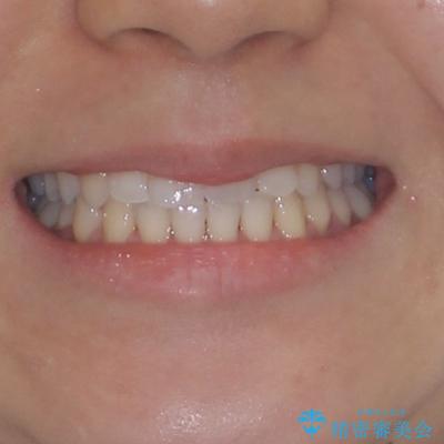 骨格的な問題を側方拡大で解決 ワイヤー矯正治療の治療後(顔貌)