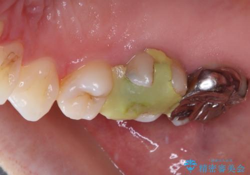 金属の詰め物が取れた。セラミックを入れたい! オールセラミッククラウンの治療前