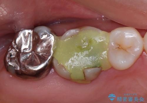 金属の詰め物が取れた。セラミックを入れたい! オールセラミッククラウンの治療前