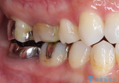 金属の詰め物が取れた。セラミックを入れたい! オールセラミッククラウンの治療前